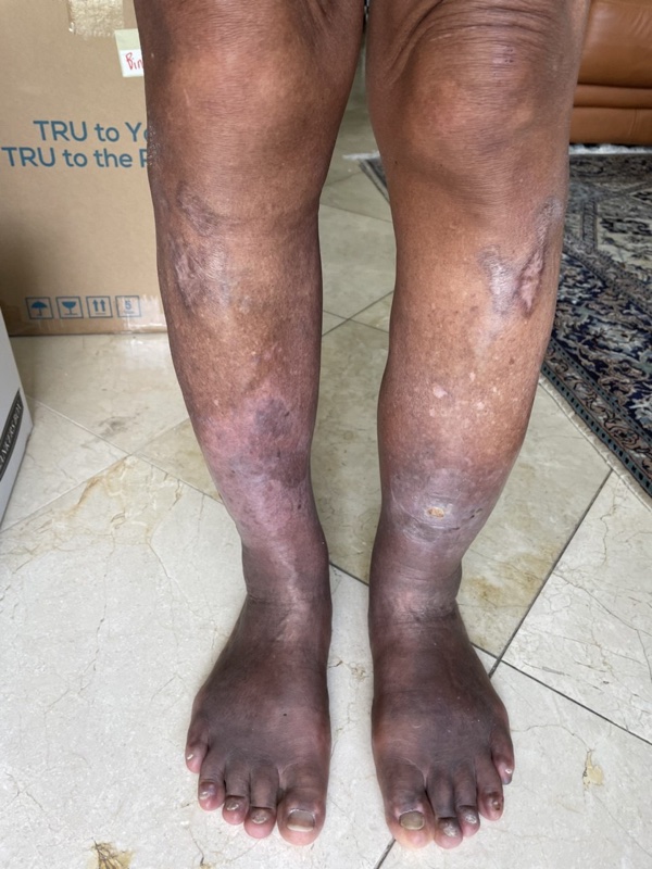 Leg healed, September 2025 - click to read the full story