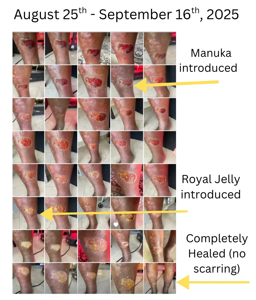 Leg ulcer healing chart, August 25 to September 16, 2025